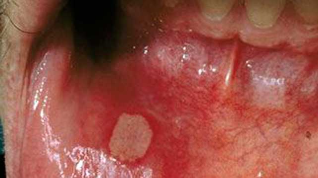 informasi stomatitis 